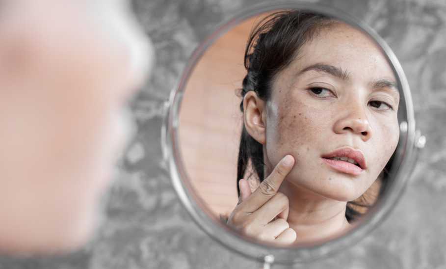 dark spots on face